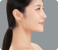 蒜頭鼻鷹鉤鼻矯正