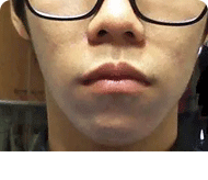 短鼻朝天鼻矯正